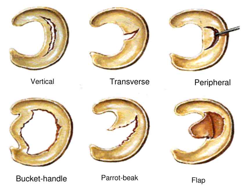 meniscus gescheurd